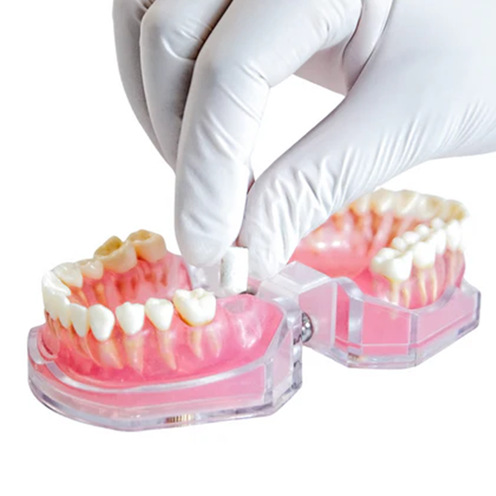 AlloFiber™ Allograft Bone Plug – DoWell Dental Products, Inc.