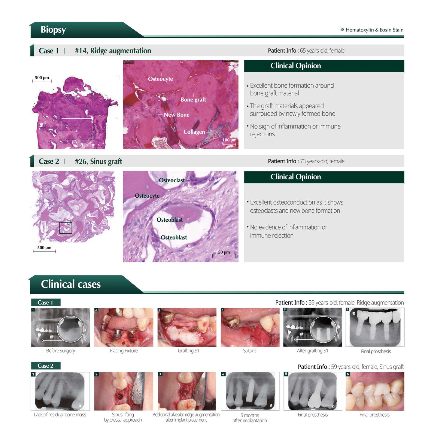 S1-Bovine Sticky and Moldable Xenograft Bone 