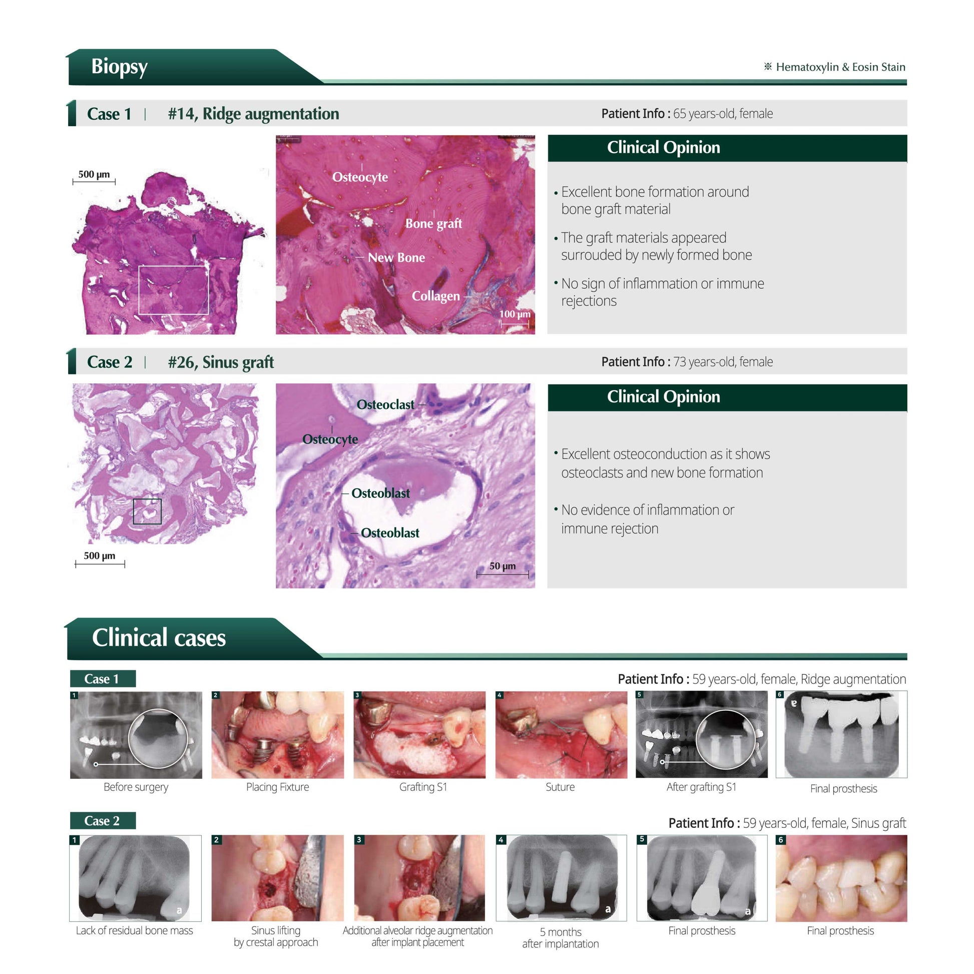 S1-Bovine Sticky and Moldable Xenograft Bone 