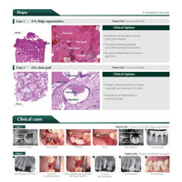 S1-Bovine Sticky and Moldable Xenograft Bone 