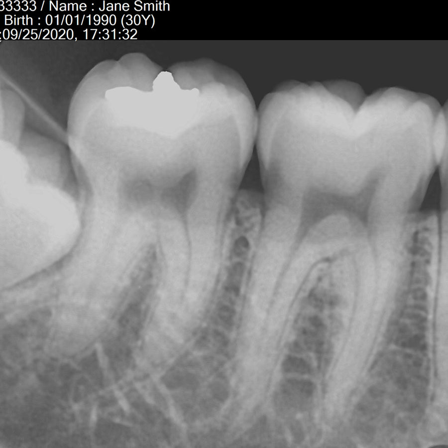 dental x-rays. Dental image sensors. Digital Intraoral Image Sensor