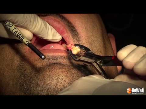 Video of Atraumatic Extraction Flexible Periotomes Kit 3pcs - Periotomes and Root Extractor pulling out teeth and a broken root