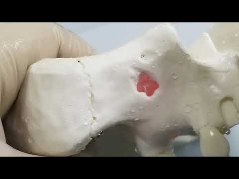 PIEZO ULTRASONIC SURGERY SINUS TIPS - CRESTAL APPROACH