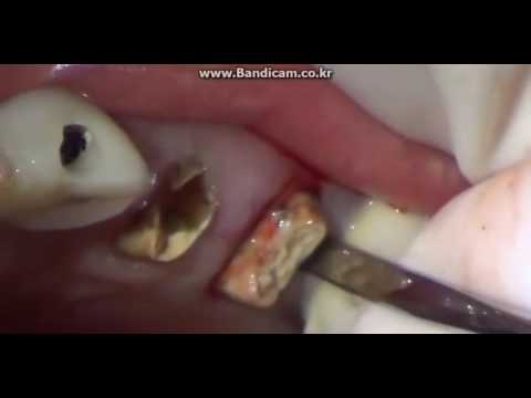 Sensitive material of Flexible Periotome - Straight extracting a rotten tooth. Flexible Periotome