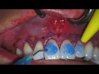 Sensitive material. Oral surgery. Periodontal Microsurgery VISTA 6 Tunneling-Blue Titanium