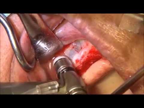 oral surgery Zirconia Dome Drill