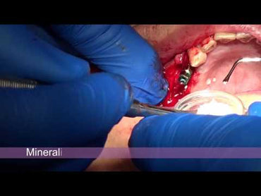 Implant Surgical Zirconia Sinus Lift Kit