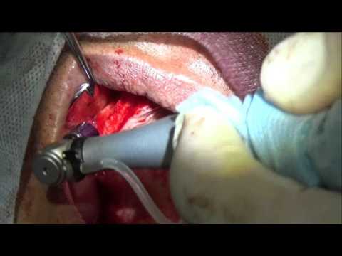 sensitive material of a video of Zirconia Dome Drill