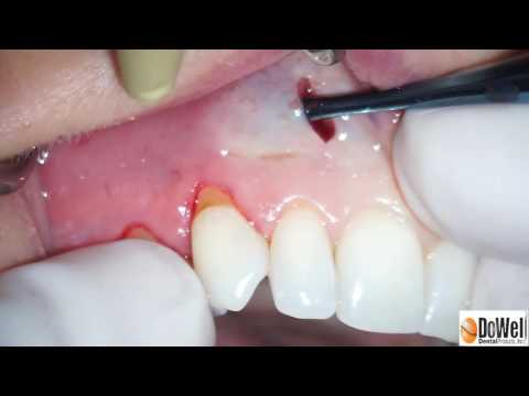 PIEZO ULTRASONIC SURGERY IMPLANT SITE PREPARATION TIPS-2.0mm LOWER