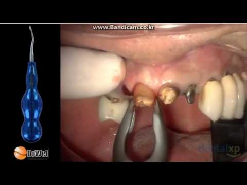 Sensitive material. Atraumatic Extraction Spade Elevator Distal-Blue Titanium extracting rotten teeth out.