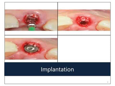 Piezo Ultrasonic Surgery Implant Preparation Tips Set