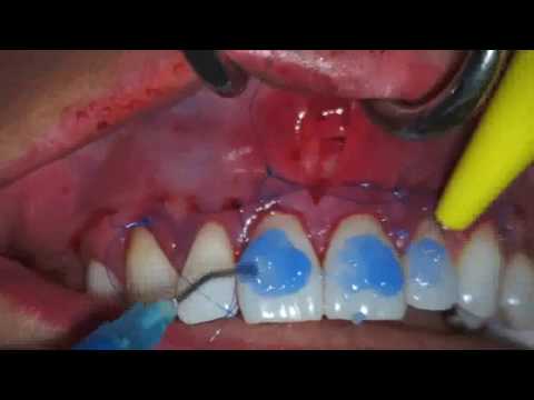 Sensitive material of oral surgery using Periodontal Microsurgery VISTA 3 Tunneling-Blue Titanium